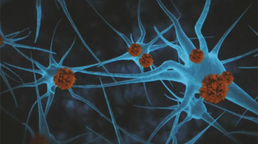 Alzheimer