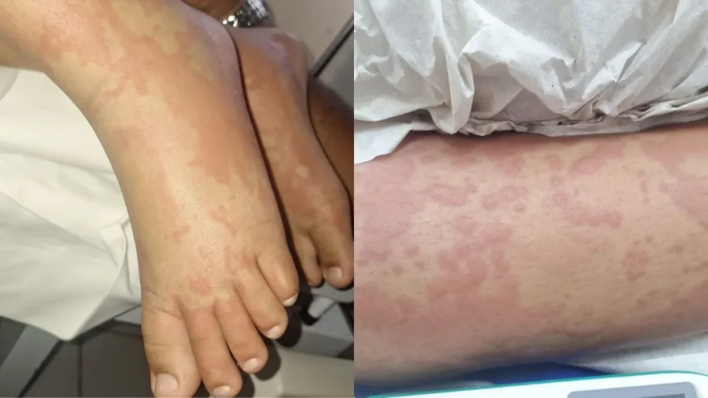 detergente Ypê contaminação